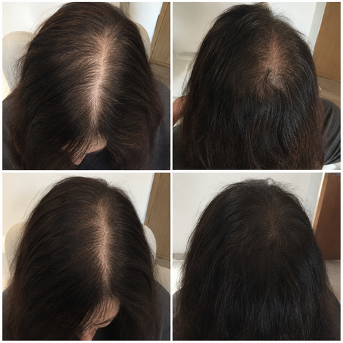 Elovia™ Korean Scalp Revival Bar